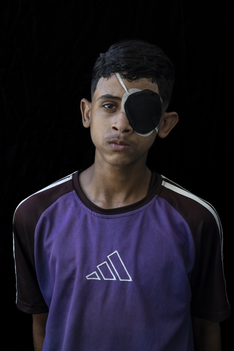 Gazze'de binlerce çocuk İsrail saldırılarında uzuvlarını kaybetti