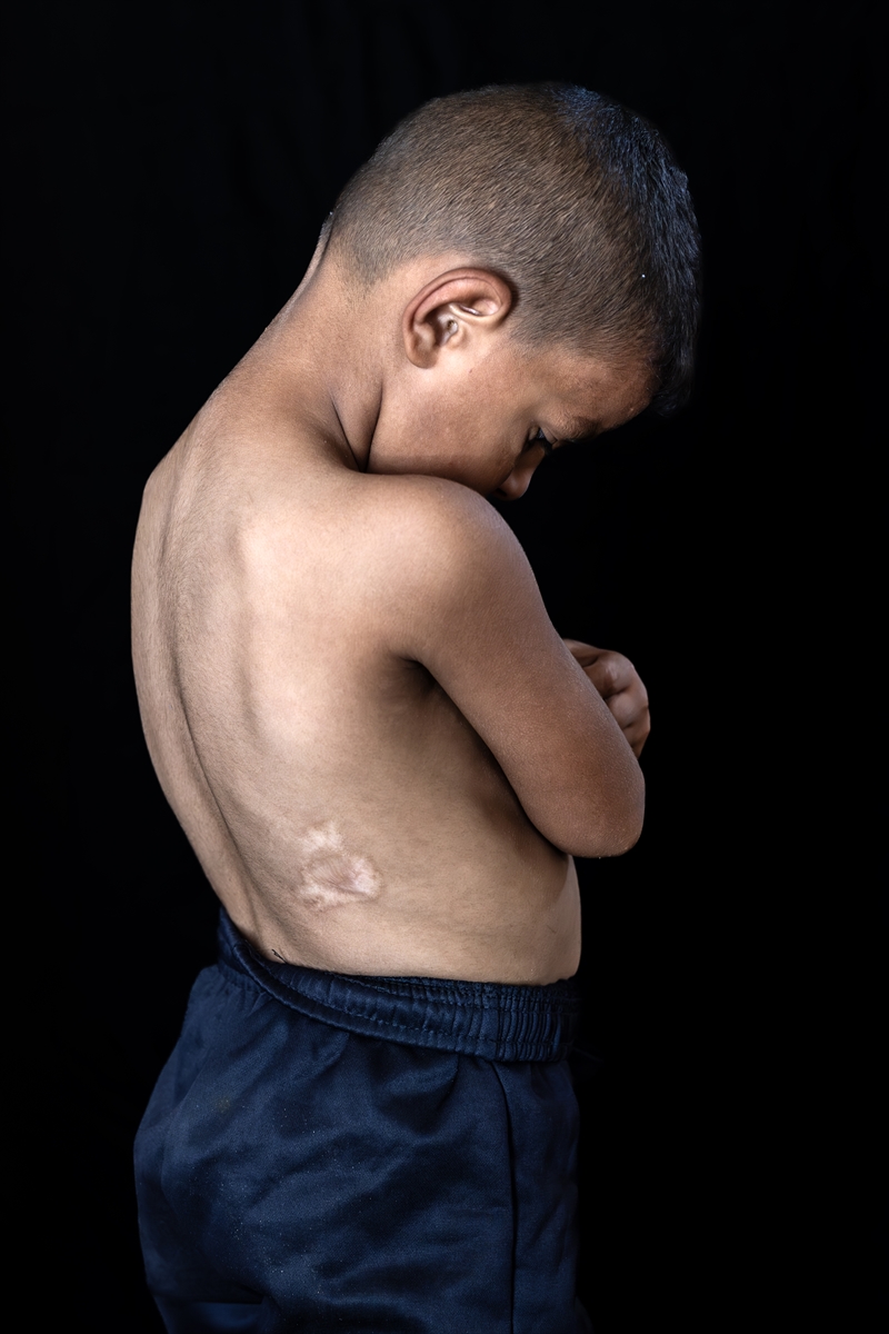 Gazze'de binlerce çocuk İsrail saldırılarında uzuvlarını kaybetti