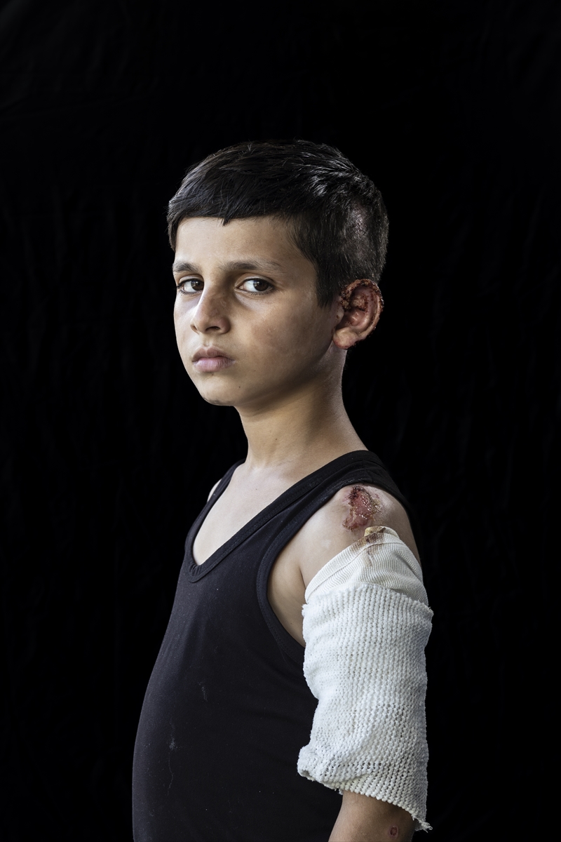 Gazze'de binlerce çocuk İsrail saldırılarında uzuvlarını kaybetti