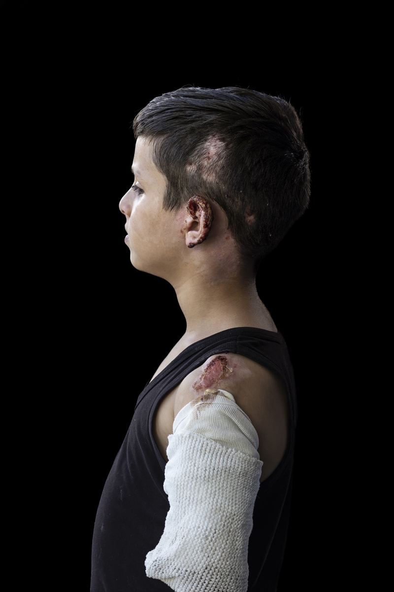 Gazze'de binlerce çocuk İsrail saldırılarında uzuvlarını kaybetti