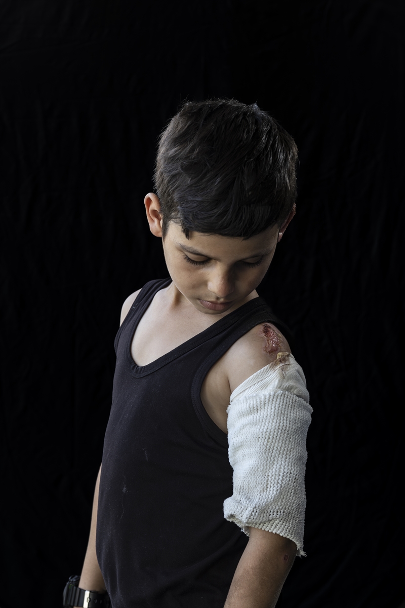 Gazze'de binlerce çocuk İsrail saldırılarında uzuvlarını kaybetti