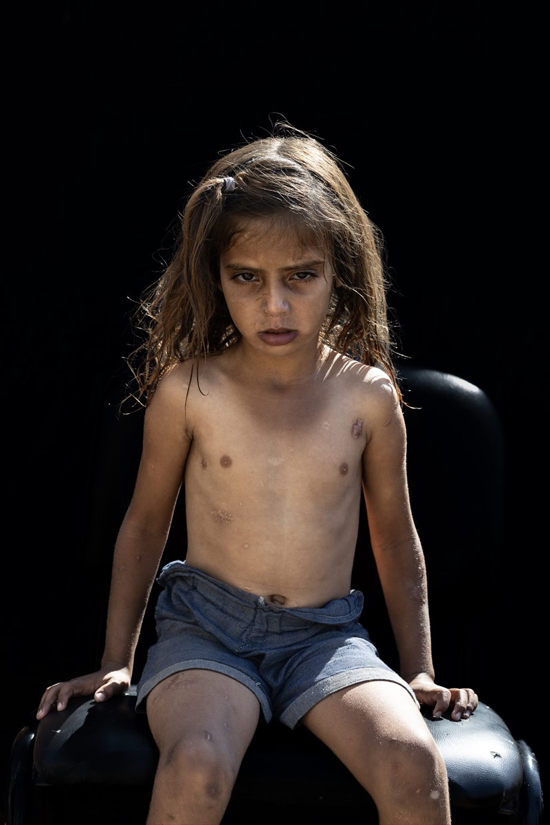 Gazze'de binlerce çocuk İsrail saldırılarında uzuvlarını kaybetti