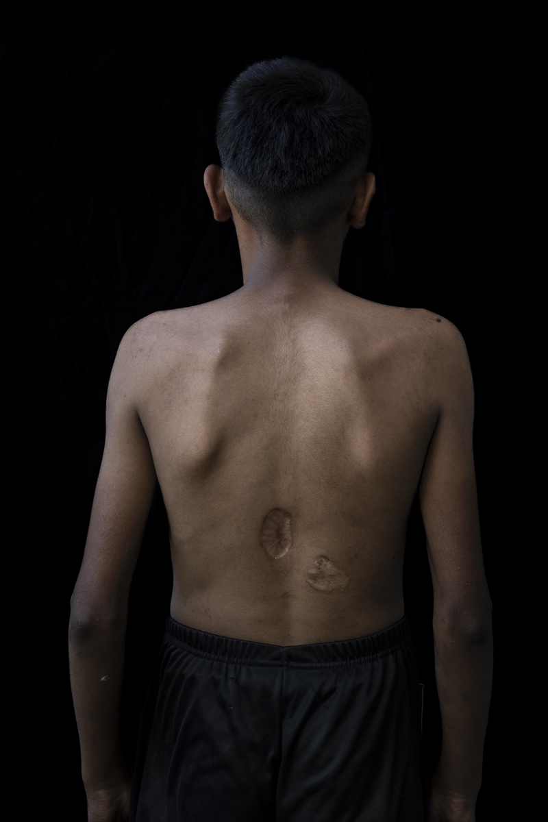 Gazze'de binlerce çocuk İsrail saldırılarında uzuvlarını kaybetti