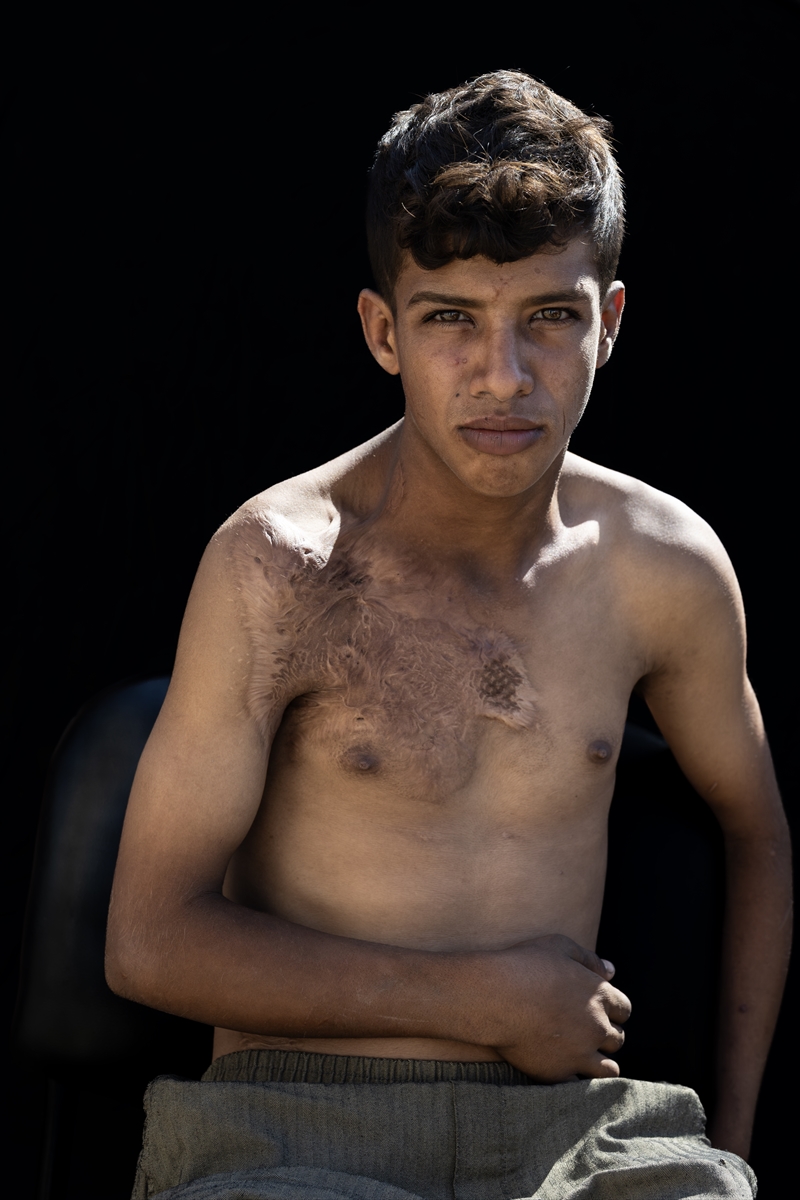 Gazze'de binlerce çocuk İsrail saldırılarında uzuvlarını kaybetti