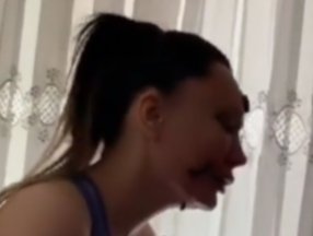 Umut Akyürek yüzüne sülük koydurttu