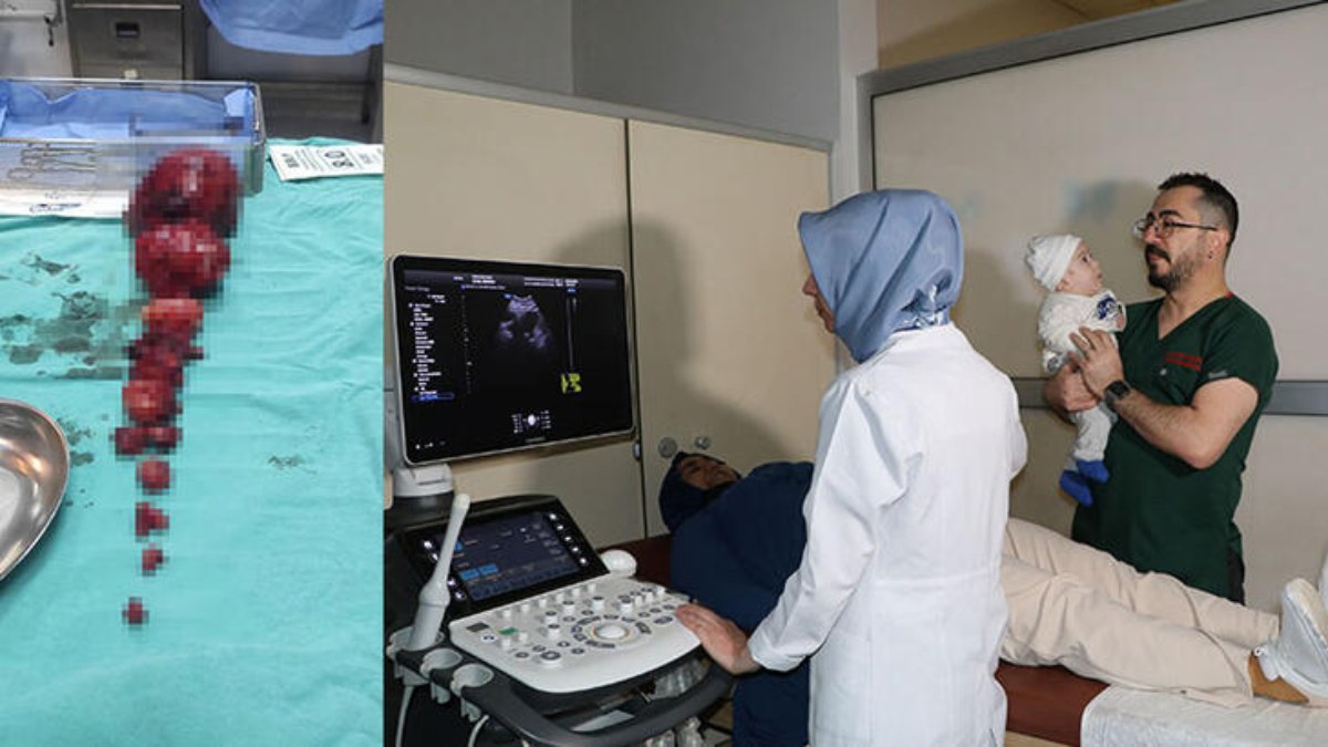 5 kilos of fibroids were removed from the womb of a pregnant woman in Van