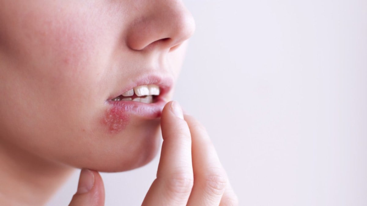Natural ways to cure herpes!  How to treat herpes at home?
