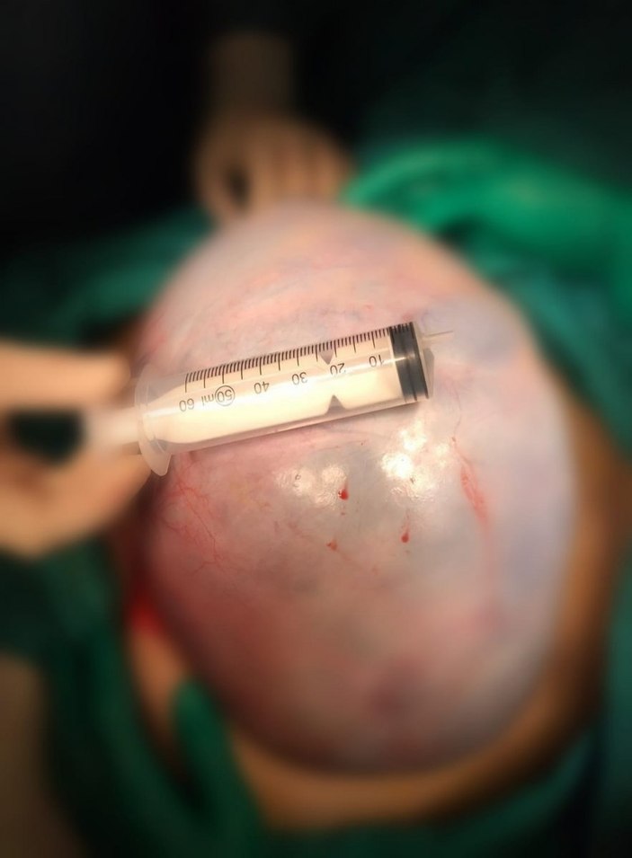 Antalya'da karın ağrısıyla hastaneye gitti, 20 kiloluk kitle çıkarıldı