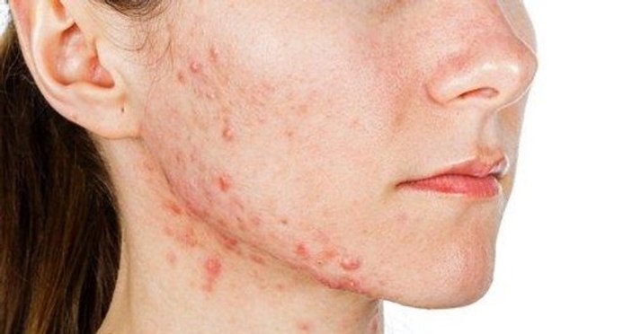 What is acne?  What are the symptoms, how is it treated?