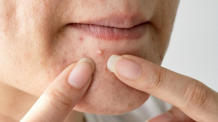 What is acne?  What are the symptoms, how is it treated?