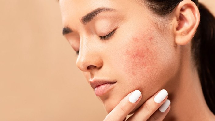 What is acne?  What are the symptoms, how is it treated?