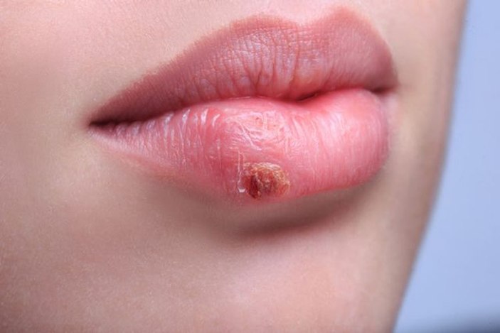 Natural ways to pass the cold!  How to treat herpes at home?