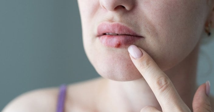 Natural ways to pass the cold!  How to treat herpes at home?