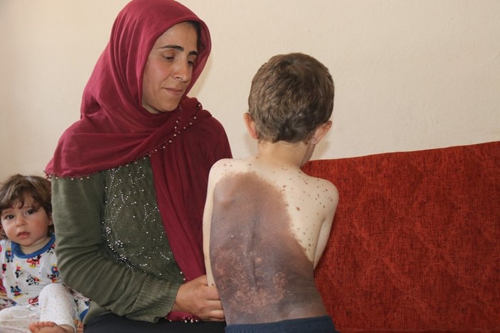 Bitlis'te kk ocuun vcudunu dev benler sard: Tedavi olmak istiyor