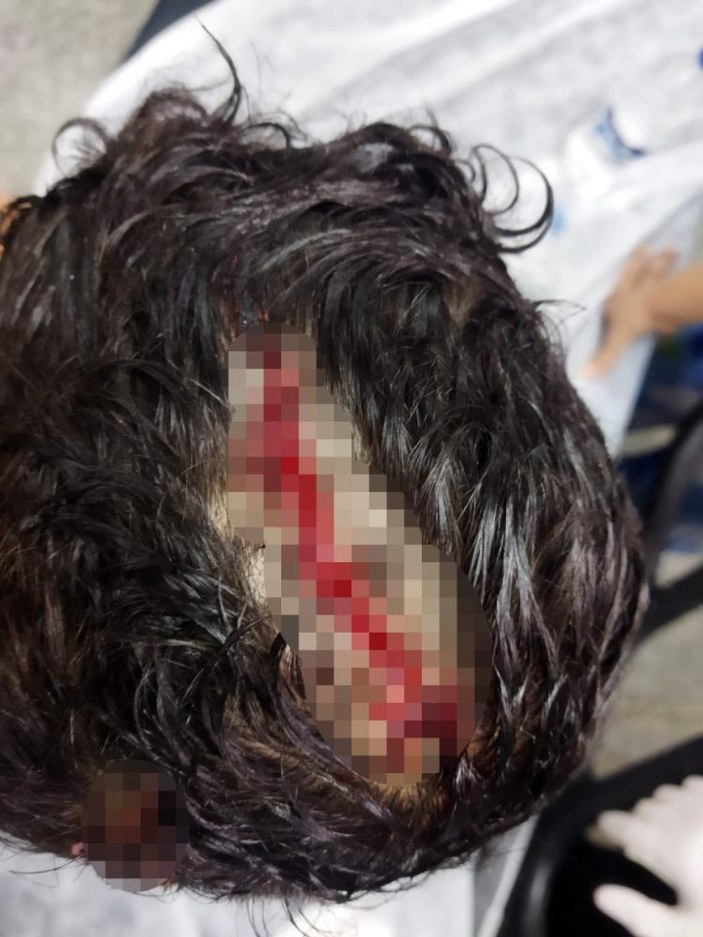 Gaziantep'te 8 yaşındaki çocuğa köpek saldırdı: Kafatasında derin yaralar oluştu